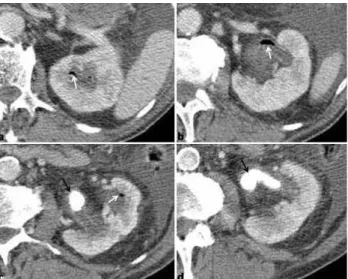 Fig. 17 - Emphysematous pyelitis. Axial contrast-enhanced CT images (nephrographic phase) show a dilated collecting system with multiple air bubbles (white arrows)