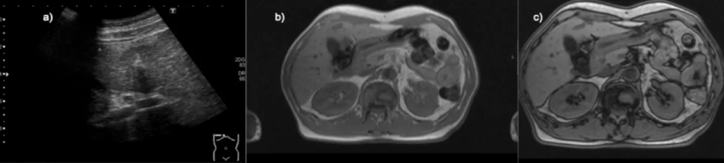 Fig. 8 - Esteatose focal. a) Ecografia hepática demonstrando área subcapuslar de hiperecogenicidade