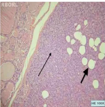 Figure 1 Lipoadenoma in thyroid gland encapsulated nodule.