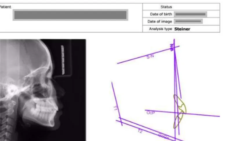 Figure 3. Results from software Planmenca Romexis Ceph. Analysis  2.2.3.2 Taking Cephalometric films for research objects 