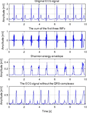 Fig. 2:The steps needed to eliminate QRS-complexes from  an ECG signal. 