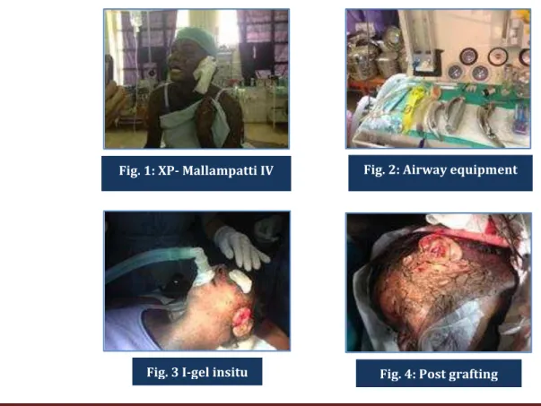 Fig. 3 I-gel insitu  Fig. 4: Post grafting 