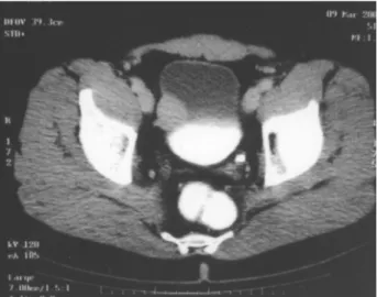 Figure 1 – Pelvic computerized tomography, showing tumor in right lateral wall of the bladder.
