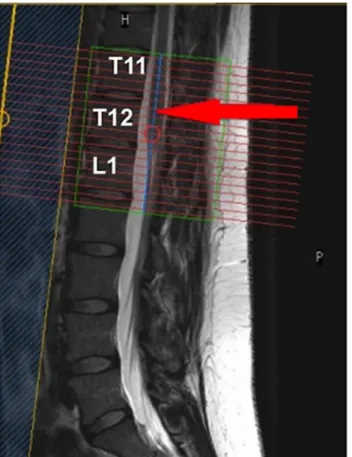 Fig 1. Prescription of the imaging volume between T11-L1 vertebral level to ensure coverage of the lumbosacral enlargement (LSE)