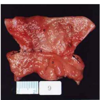 FIGURA 17 - Fotografia mostra peça operatória aberta longitudinalmente. Colédoco dilatado (C), anastomose diminuída (A) e duodeno (D).