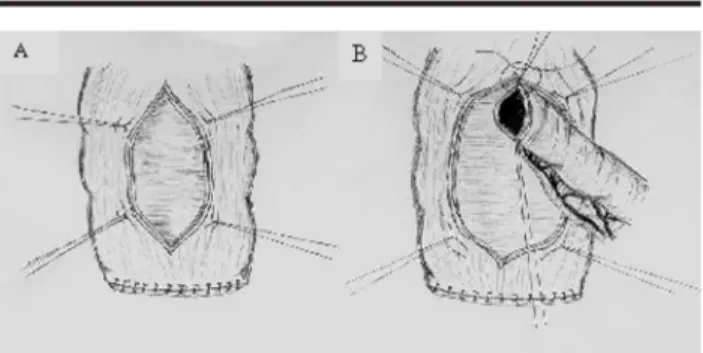 FIGURA 2: A) Fechamento da camada seromuscular criando um túnel submucoso. B) Visão lateral das fases fisiológicas da neoválvula ileocecal.