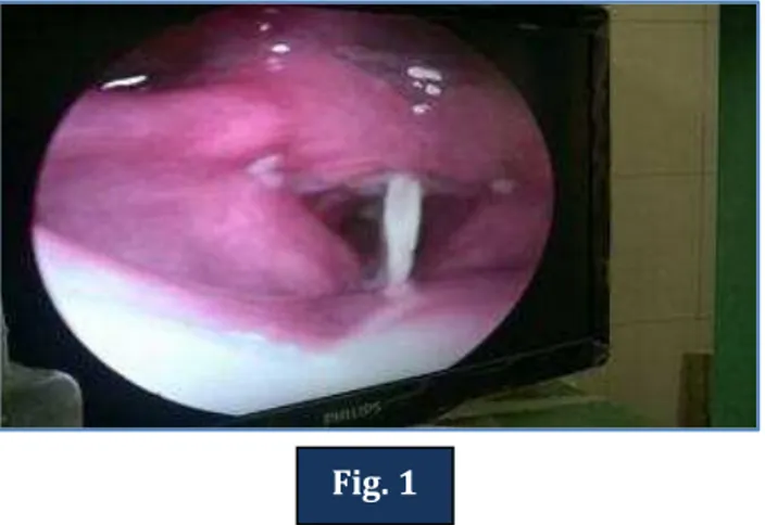 Fig. 1: Indirect laryngoscopy picture showing foreign body lying antero-posteriorly in glottis