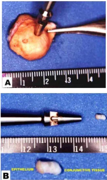 FIGURE 2 - Patient donor of the keloid, with clinically active lesions in the superior-medial quadrant of right and left breasts.