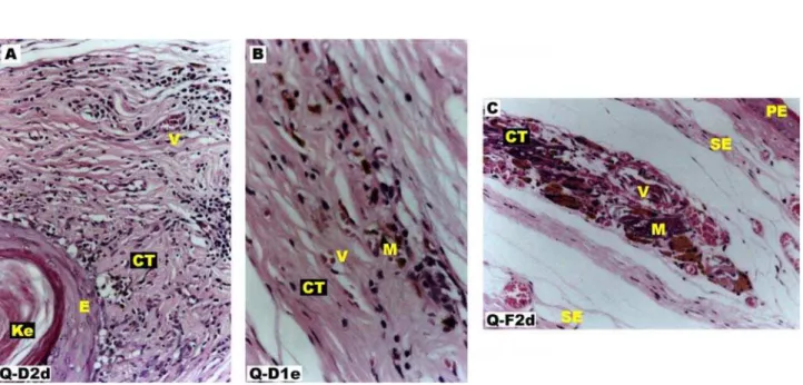 FIGURE 9 - Microscopic fragments of grafted keloid from 42 days to 168 days (HE). A) At 42 days, presence of whole epithelium with keratin cysts (x200)
