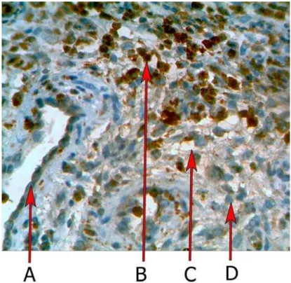 Fig. 2. Immunoexpression of MPO in chronic inflammation. A – vessel; B – MPO positive cells; C – edema; D - MPO nega- nega-tive cells