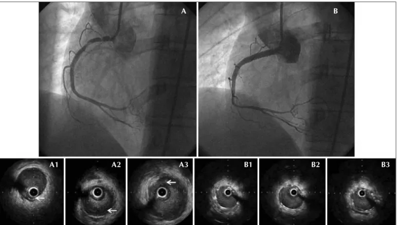 Figura - Coronariografia em oblíqua anterior esquerda, mostrando: (A) dissecção de terço proximal de artéria coronária direita; (B) resultado pós-intervenção coronária percutânea com stent em terço proximal de artéria coronária direita; (A1) ultrassom intr