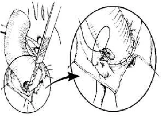 Fig. 2 ­ Esquema mostrando o tronco da artéria coronária esquerda já reimplantado e o início do reimplante da artéria coronária direita