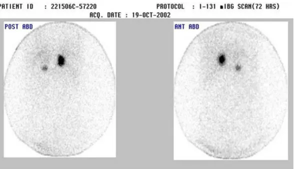 Figure 3. CT scan showing bilateral adrenal tumors.