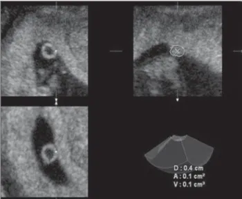 Figure 1. Yolk sac volume calculation by the  multi-planar method: on the axial plane, the cursor is  dis-placed from one to the other extremity of the yolk sac at 1.0 mm intervals, with simultaneous manual delimitation of the yolk sac outer surface on the