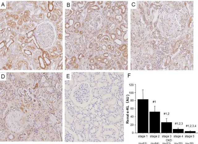 Figure 1. Reduction of renal a-Klotho (a-KL) expression with progression of CKD. (A–D) Representative images showing immunoperoxidase staining of a-KL in renal biopsy sections from CKD patients at (A) stage 1, (B) stage 3, (C) stage 5 and (D) stage 5 HD