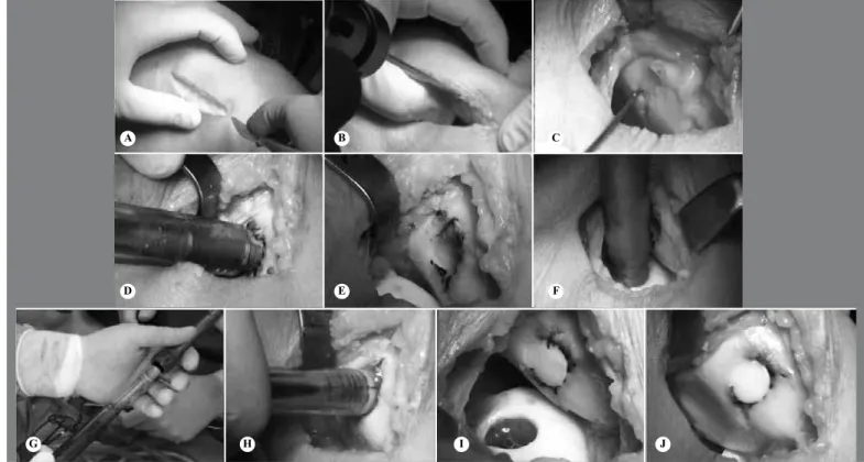 Figure 1 – Surgical technique for autologous osteochondral transplantation in cases of patellar chondral lesion