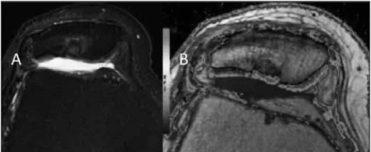 Figure 3 – (A) Magnetic resonance images in the axial plane; (B)  Six months after patellar mosaicplasty on the right knee
