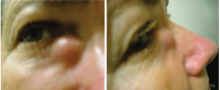 Figura 1.  Fotografia parcial da face da criança com dacriocistocele congênita do lado direito