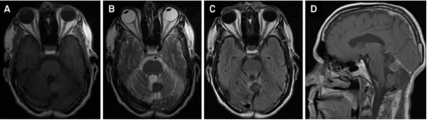 Figure 1. (A) Brain MRI disclosing a hyperintense lesion in the superior vermis on axial T1-weighted images; (B) hypointense on axial T2; (C) FLAIR-weighted sequences; and (D) with ring-enhancing on sagittal post-gadolinium T1-weighted images.