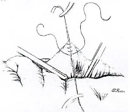 Figura 3 ­ Desenho esquemático do reparo de ferimento de colo por sutura primária   Os atos operatórios foram realizadas no laboratório de Técnica Operatória da Universidade Estadual de Maringá