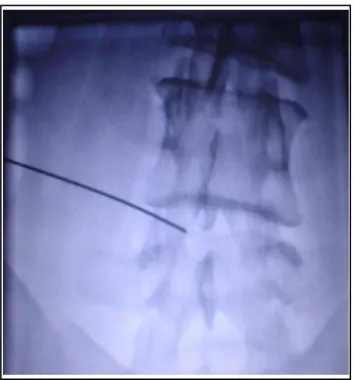 Fig 2-Antero Posterior View of L-S Spine (showing position of the needle)