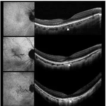 Figure 1. Examples of indocyanine green angiography (ICGA) and spectral domain optical coherence tomography (SD-OCT) in highly myopic eyes