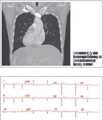 Abbildung 4: EKG eines Patienten mit Situs inversus und Vorhofflimmern