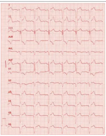 Abbildung 5: EKG eines Patienten mit Situs inversus und Linksschenkelblock
