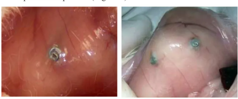 FIGURE 1 - No adhesion found and peritonealization of the  titanium tacks was observed.