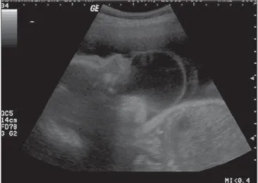 Figure 2. Coronal section of fetal face revealing normality of the nose and upper lip, and highlighting the increased diameter of the cystic mass.