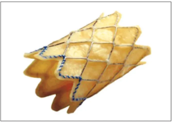 Figure 1 – External aspect of the Melody   valve. The bovine jugular  is mounted inside the CP (cheatham-platinum) stent