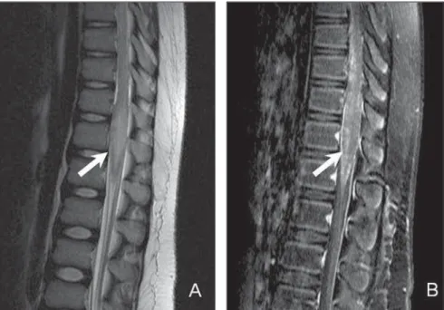 Figure 1. Twelve-year-old child diagnosed with neuroschistosomiasis. Sagittal MRI T2-weighted sequences (A), remarkable, central hypersignal with ill defined limits (arrow), besides volumetric increase of the conus medullaris obliterating the anterior and 