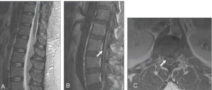 Figure 6. MRI study of a patient diagnosed with neurosarcoidosis, showing a slight increase of the conus medullaris on sagittal (A) T2-weighted sequence, with no alteration in central signal, with post-contrast pial and radicular enhancement (arrows on B a