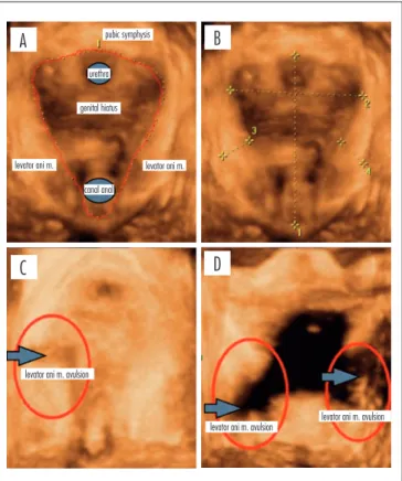 Figure 1. Axial plane of the female pelvic floor on the second  postpartum day in rendering mode