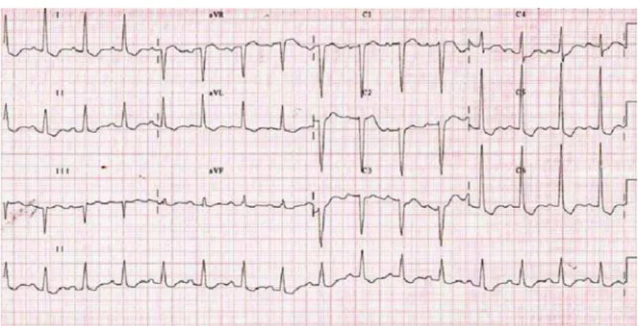 Fig. 4 – The ECG at discharge showed sinus rhythm, frequency of 80/min with signs of hypertrophy and left ventricular overload
