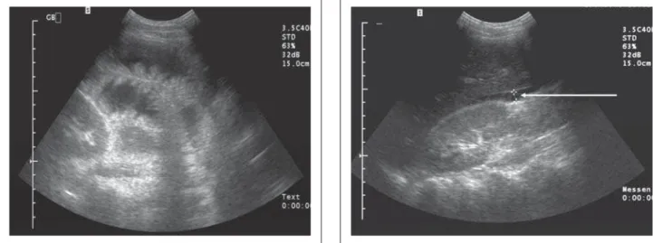 Abbildung 4:  Computertomographische Darstellung eines länger- länger-streckigen entzündlichen Verschlusses des terminalen Ileums (Pfeil) mit prästenotisch dilatiertem Dünndarm und einer geringgradigen Koprostase im Zökum