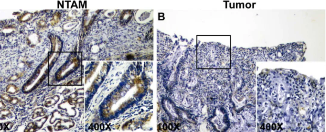 Fig 2. Immunohistochemical staining for RPRM in gastric cancer. A) Representative example of non-tumor adjacent mucosa (NTAM) showing positive cytoplasmic staining of RPRM in more than 30% of cells