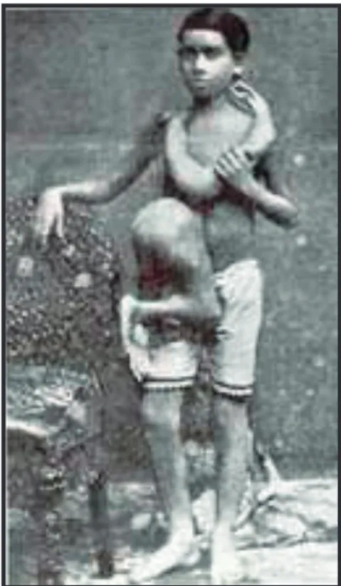 Fig.  2.  Fotografia  de  Perumal  Sami,  nascido  na  Índia  em  1888,   que carregava um irmão gêmeo perfeitamente desenvolvido,  crescen-do para fora crescen-do peito