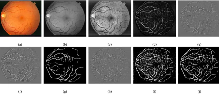 Fig 5. Proposed method main processing steps for retinal blood vessel segmentation. (a) RGB image from STARE database