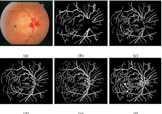 Fig 10. Pictorial results of different retinal blood vessel segmentation techniques on pathological image of STARE dataset