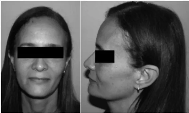 Figure 1. Patient in reported case. hin facial features, thin lips,  thin skin and paucity of subcutaneous tissue.