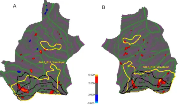 Figure 2. Localization of surface clusters where cortical thickness is significantly reduced in the POAG subjects in comparison to normal controls (p , 0.02, uncorrected) for left (A) and right (B) hemispheres