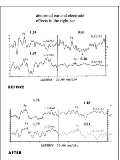 Fig 3. P300 before and after treatment. LE, left ear; RE. right ear.