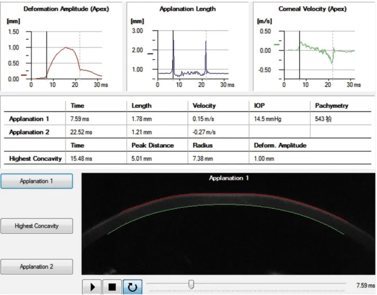 Figure 1. The real-time corneal deformation parameters of a participant recorded when the cornea was just flattened.