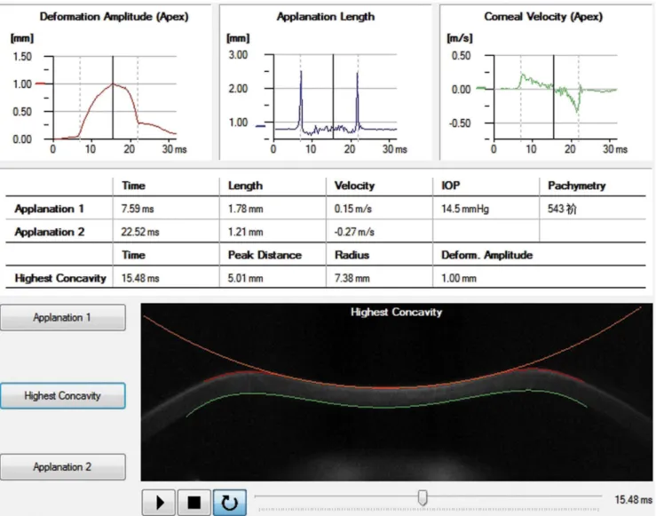 Figure 2. The real-time corneal deformation parameters of a participant recorded when the cornea was flattened to the highest concavity.