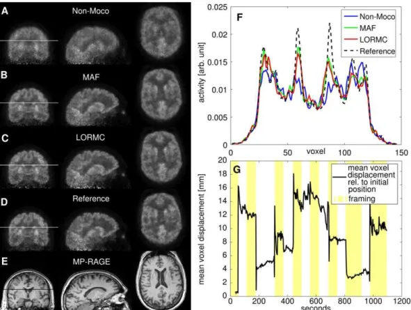 Figure 7. Patient B. (A) Non-motion corrected, (B) MAF corrected, and (C) LORMC corrected PET images, (D) reference PET image without induced motion, along with (E) the corresponding MP-RAGE image of Patient B