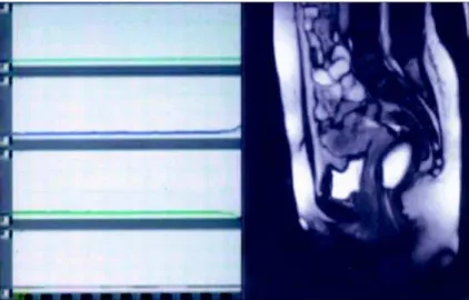 Figure 1 –  Magnetic resonance imaging video urodynamics. Synchronous display of urodynamic parameters and sagittal magnetic resonance image of the pelvis.