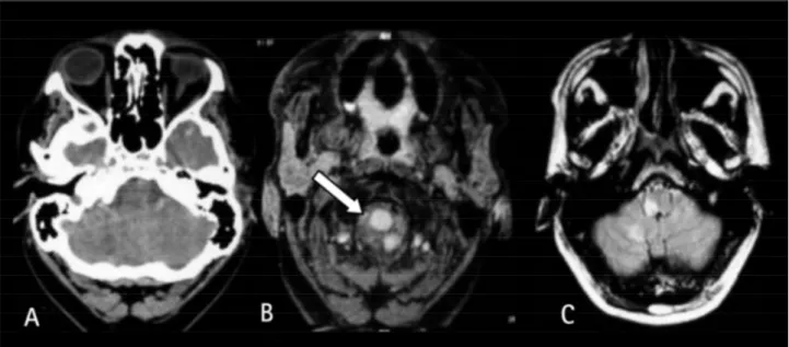 Fig 1. A) CT scanning: right hypodense cerebellar area. B-C) MRI: right medullar and cerebellar hyperintense signals on FLAIR