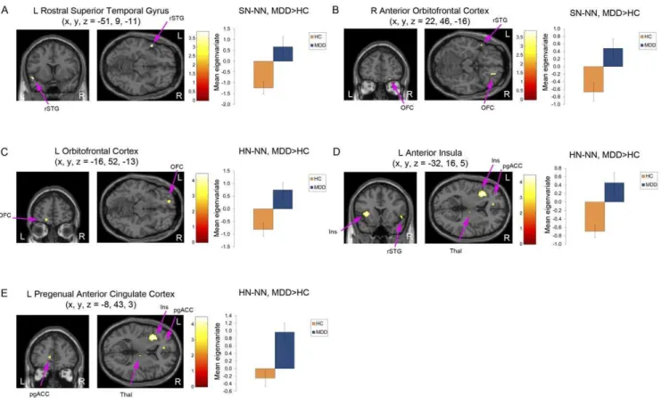 Table 2. Regional differences in the BOLD response to masked-sad faces versus masked-happy faces (SN-HN) in patients with major depressive disorder and healthy controls.