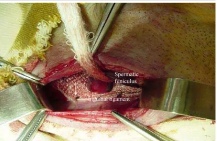 FIGURE 1 - Fixed mesh on the inguinal ligament and the spermatic funiculus, surrounded by the approximation of the edges of the opening of the mesh (arrow)